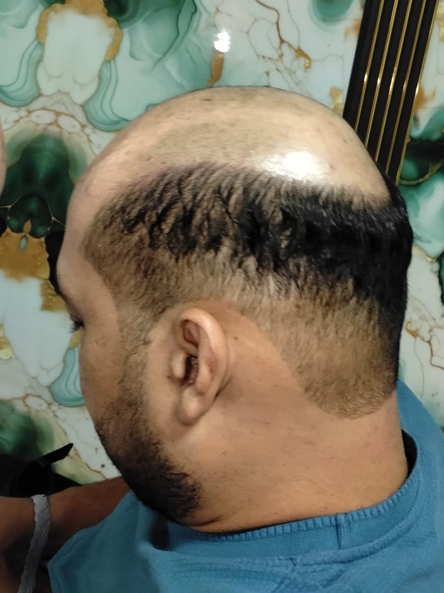 Antes: caída de cabello, vista de perfil