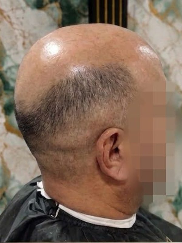 Antes: calvicie en la parte de arriba, vista de perfil