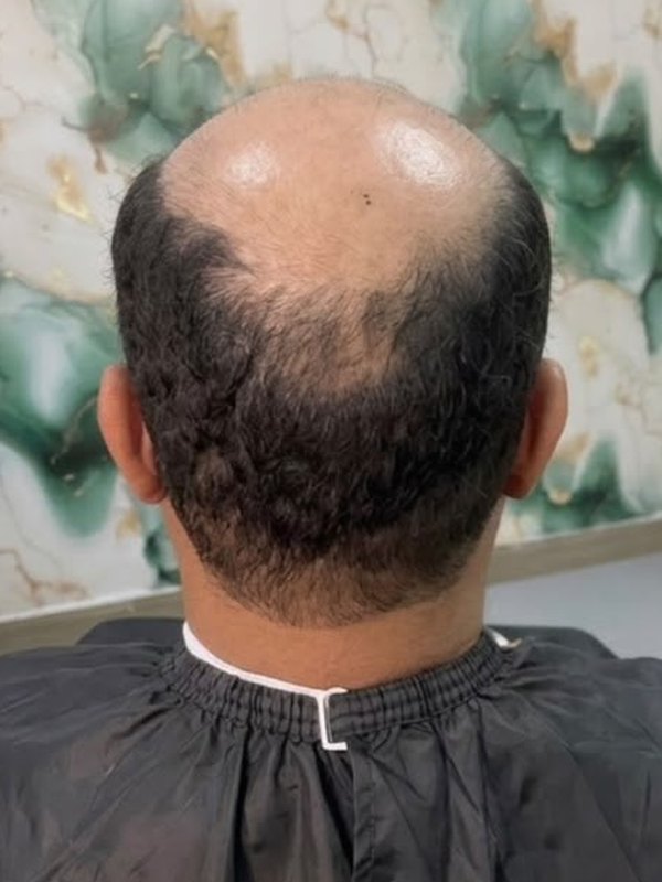 Antes de la prótesis capilar, coronilla y perfil