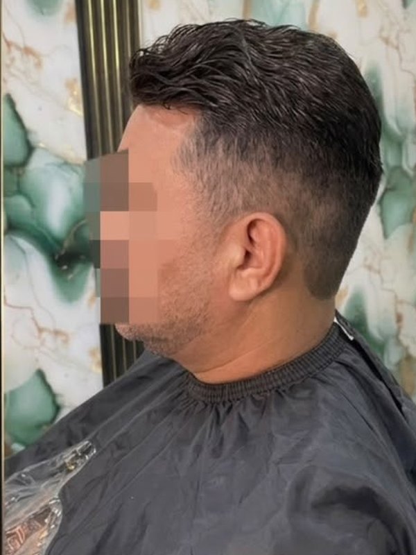 Después de la prótesis capilar, coronilla y perfil