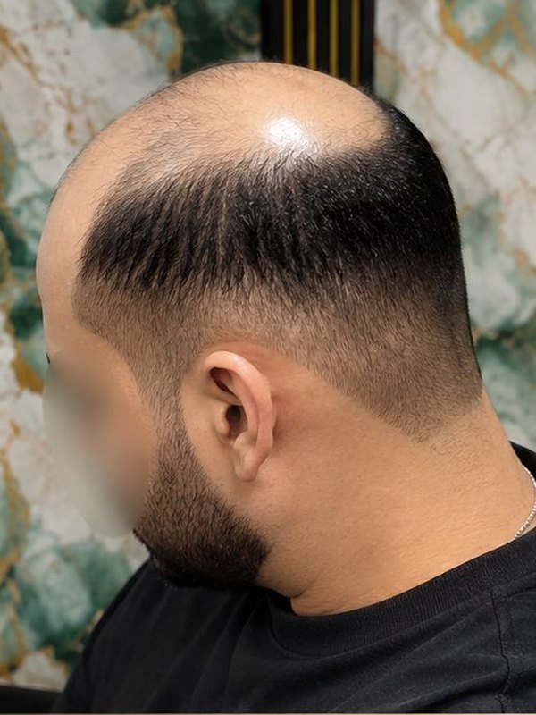 Antes de la prótesis capilar, vista de perfil