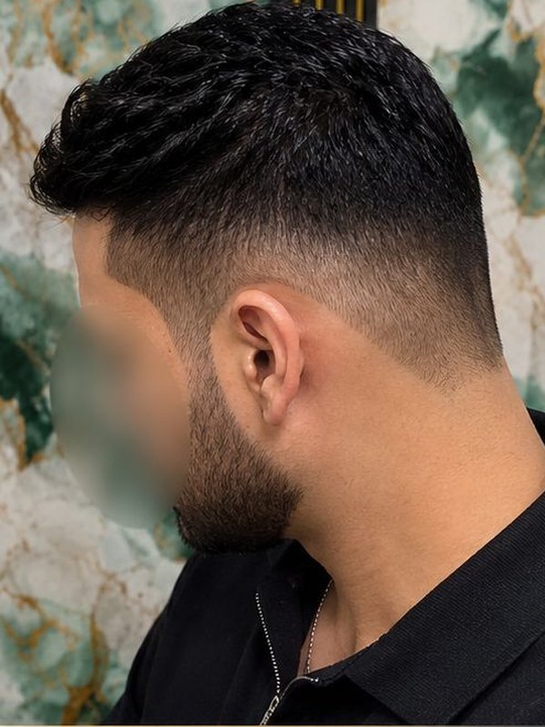 Después de la prótesis capilar, vista de perfil