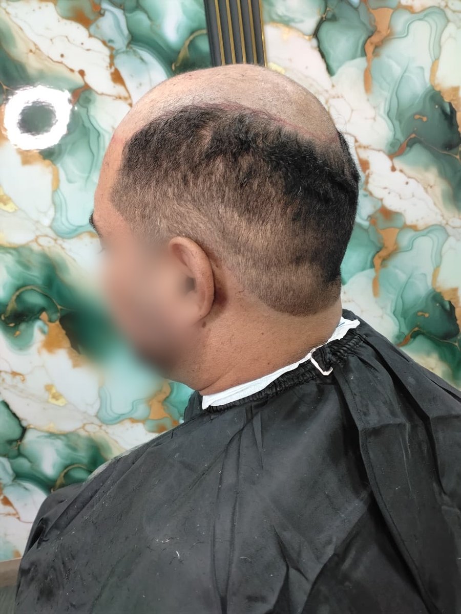 Antes: calvicie en la parte de arriba, vista de perfil